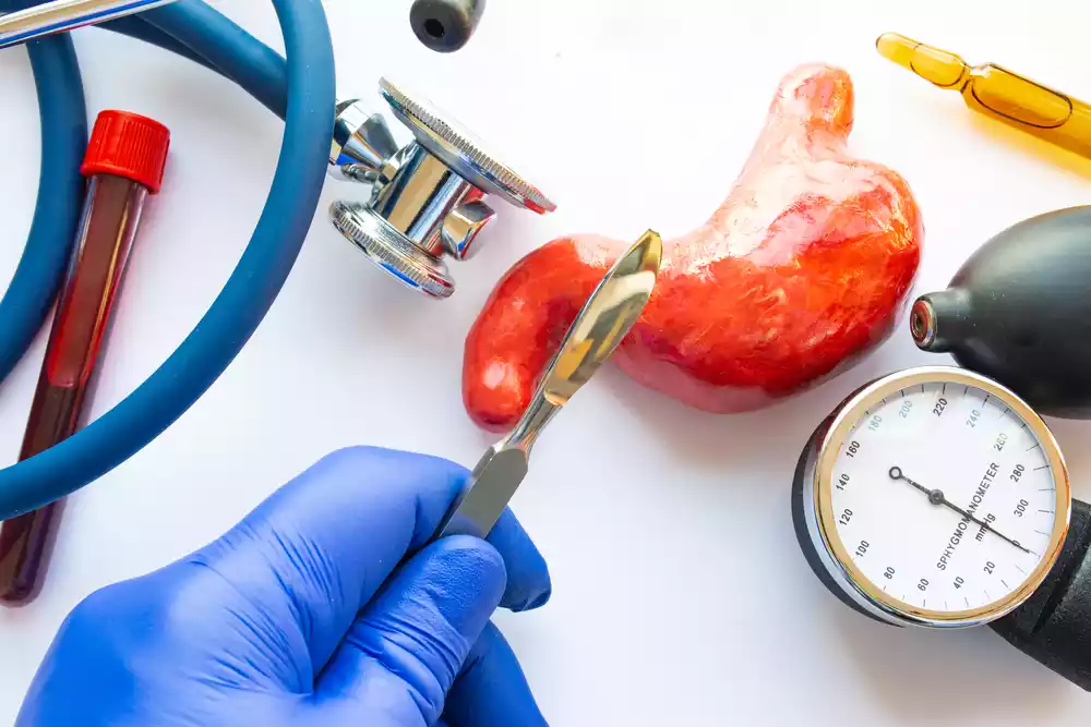 Gastric Sleeve