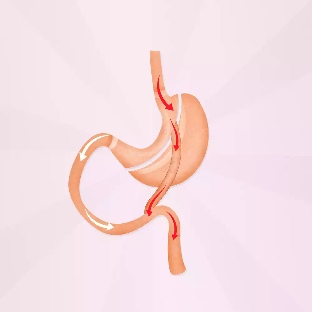 Gastric bypass