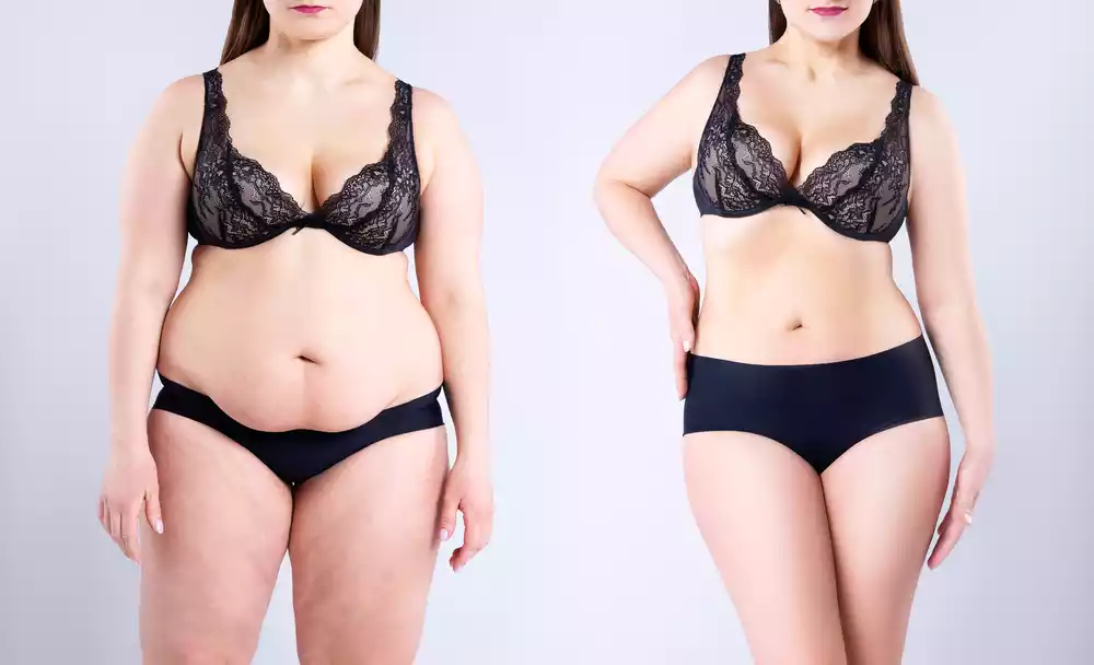 How to Minimize Loose Skin After Weight Loss Surgery