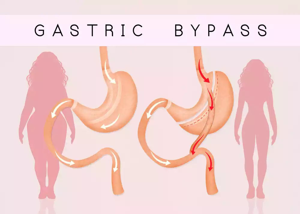 Top Benefits of Gastric Bypass Surgery