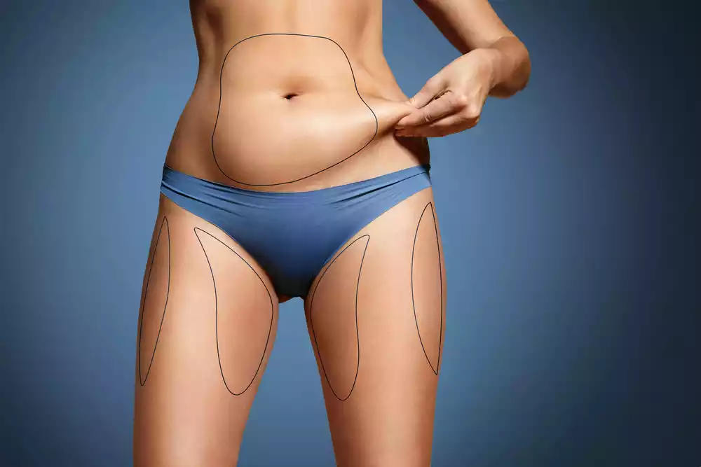 Discover the Many Benefits of Liposuction