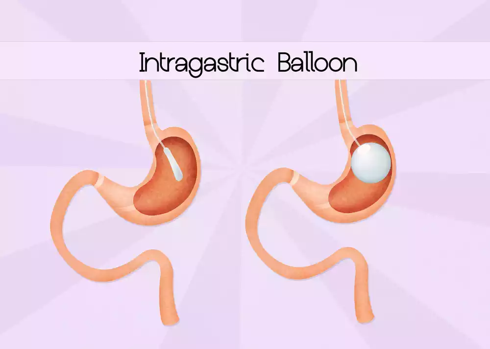 How does balloon weight loss can help you reach your goals?