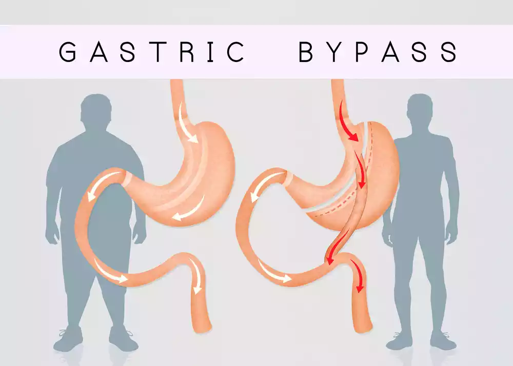 Mini Bypass vs. Bypass: Which weight loss surgery is best?